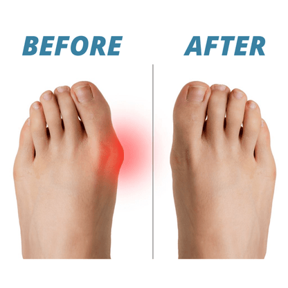 2PC Premium Bunion Corrector Sock